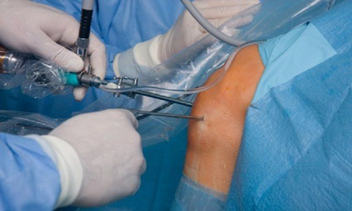 ARTHROSCOPY