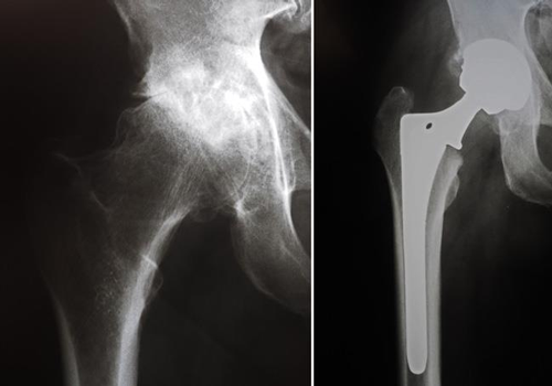 HIP JOINT REPLACEMENT