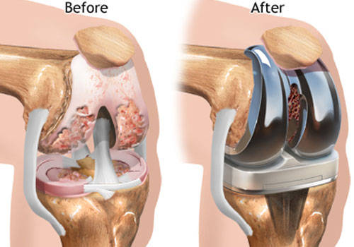 Knee Joint Replacement